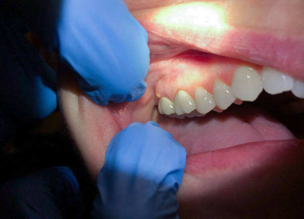 Best Emergency Root Canal Treatment in Gentry, AR